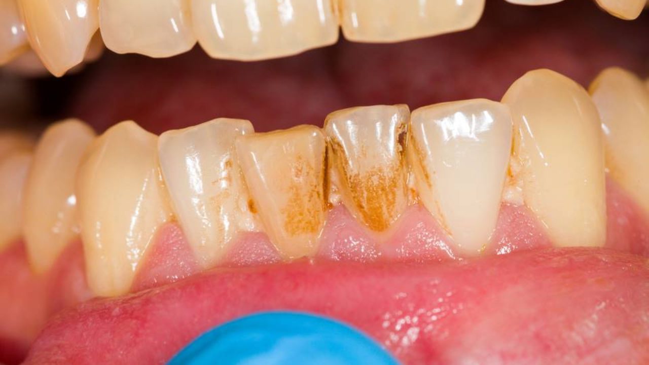 Jak změkčit zubní kámen?